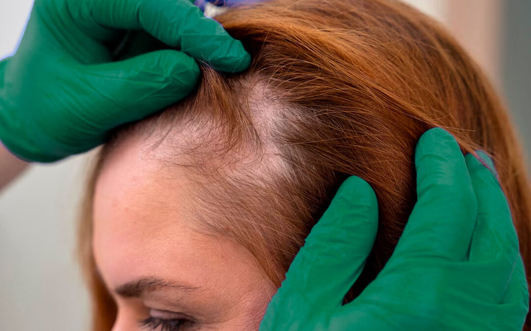 Síntomas y tratamiento de la alopecia